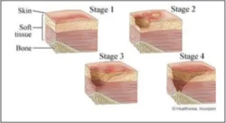 The 5 stages of a pressure wound